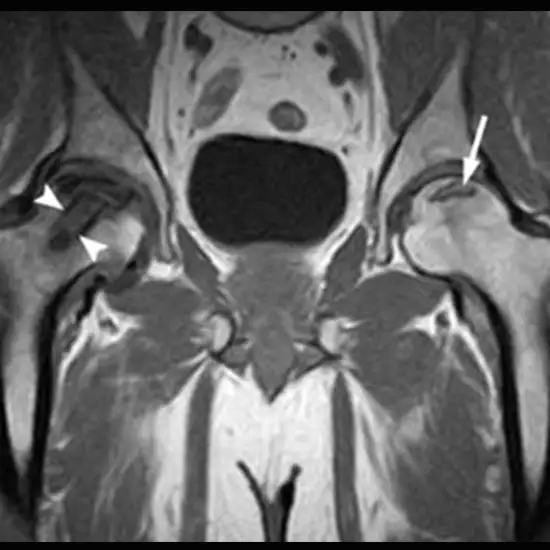 mri of hip with femoral test